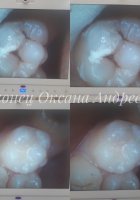 Лечение кариеса 26 зуба. Восстановление Gradia PA3,A3