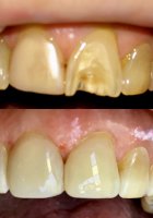 Реставрация передней группы зубов композитным материалом. Эстетическое восстановление коронковой части зуба показано при: Изменении цвета эмали. Клиновидном дефекте. Небольшом сколе. Эрозии эмали. Незначительные травмы зубов.
