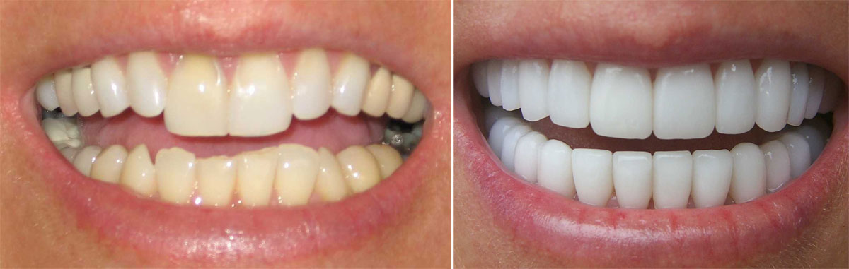 Установка виниров на зубы: до и после