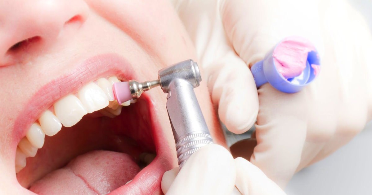 Процедура фторирования зубов в стоматологии