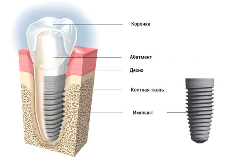 Устройство зубного импланта