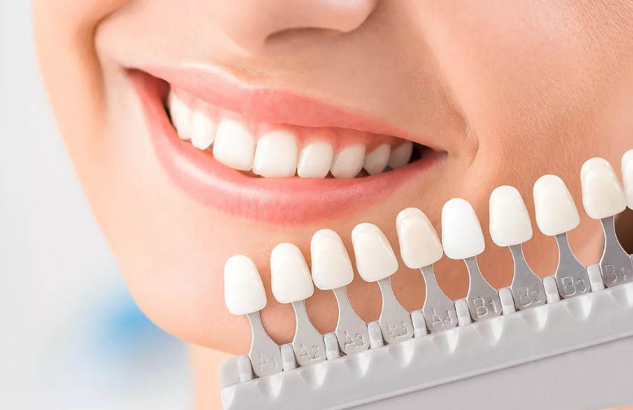 Подбор цвета эмали при отбеливании у стоматолога