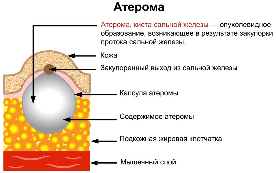 Атерома (определение)
