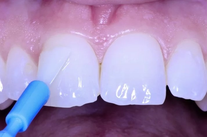 Покрытие переднх зубов фторлаком