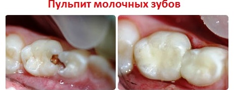 Лечение пульпита молочных зубов: до и после