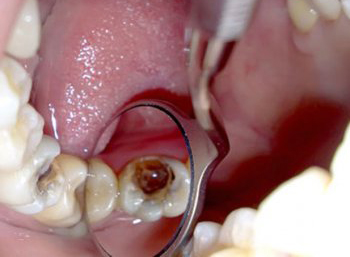 Диагностика пульпита молочного зуба