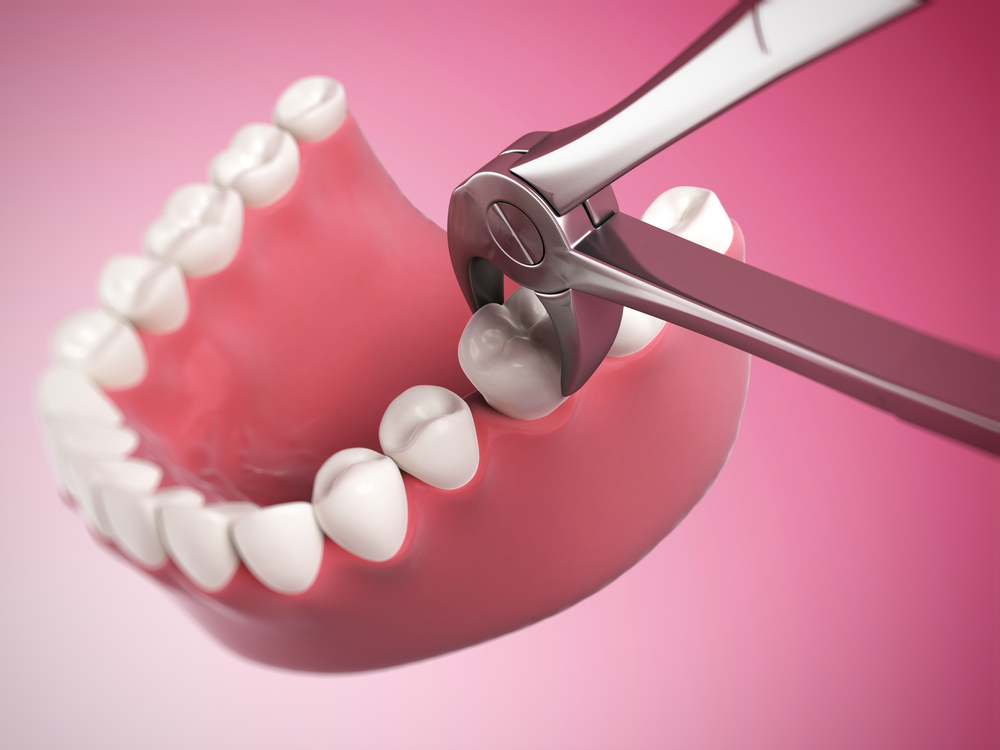 Удаление зуба стоматологом-хирургом