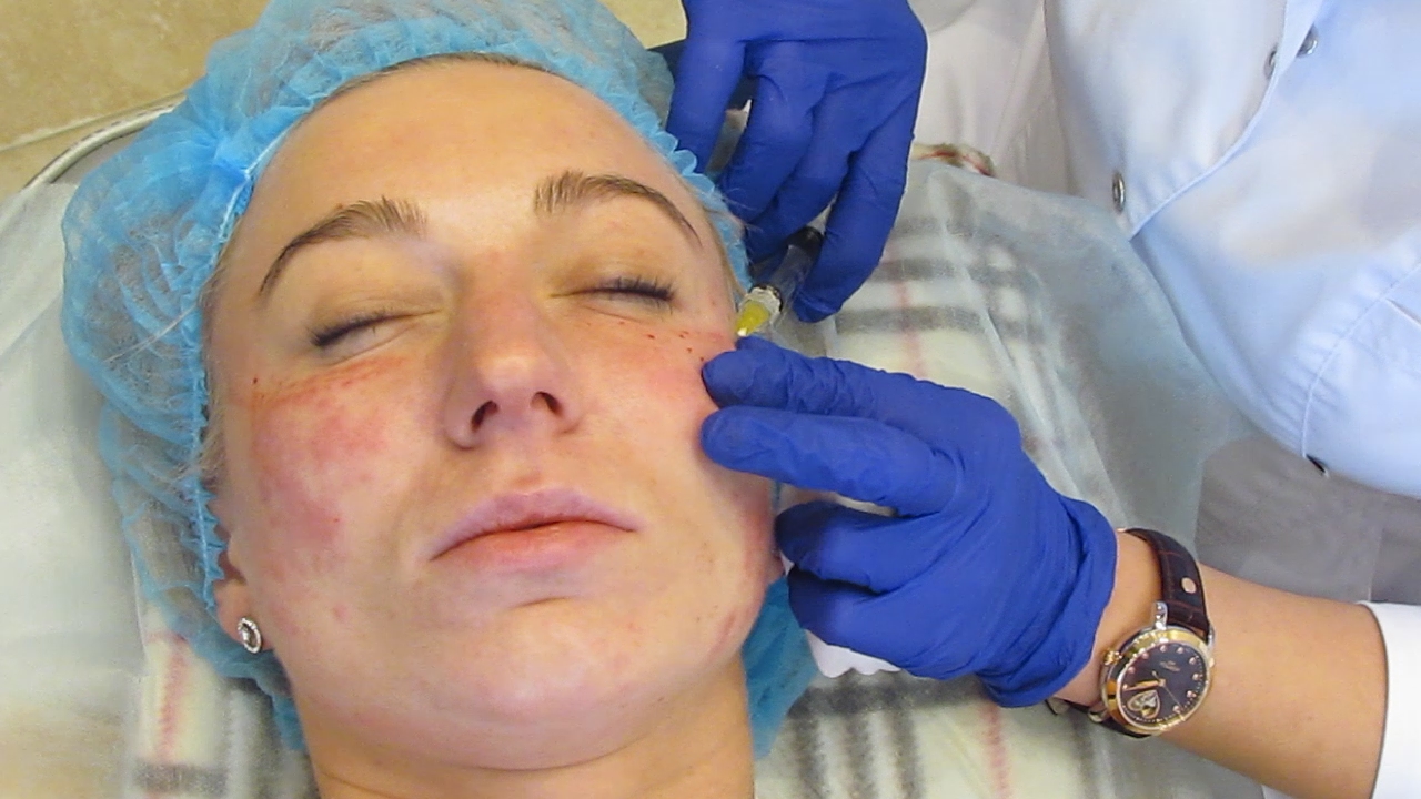 Процедура биоревитализации кожи лица в косметологии Амара