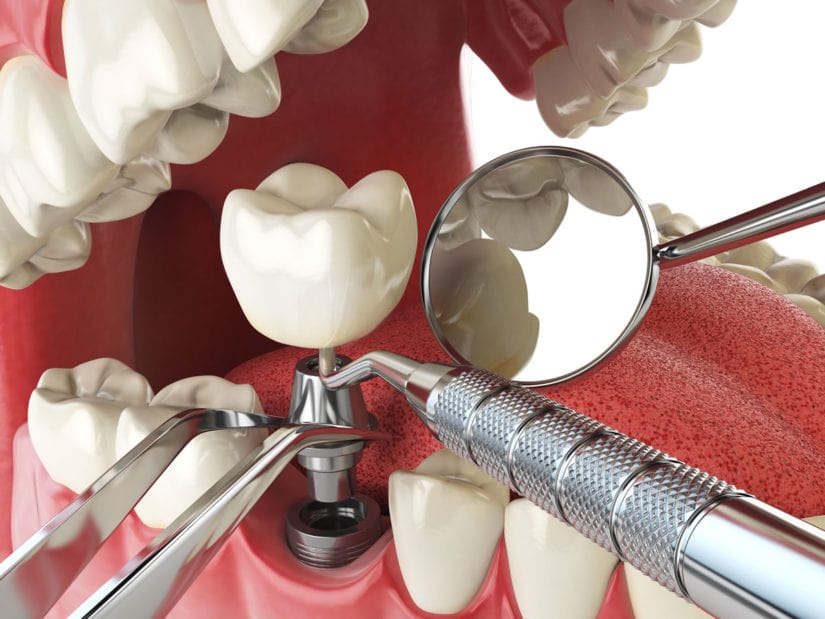 Установка импланта зуба на нижнюю челюсть
