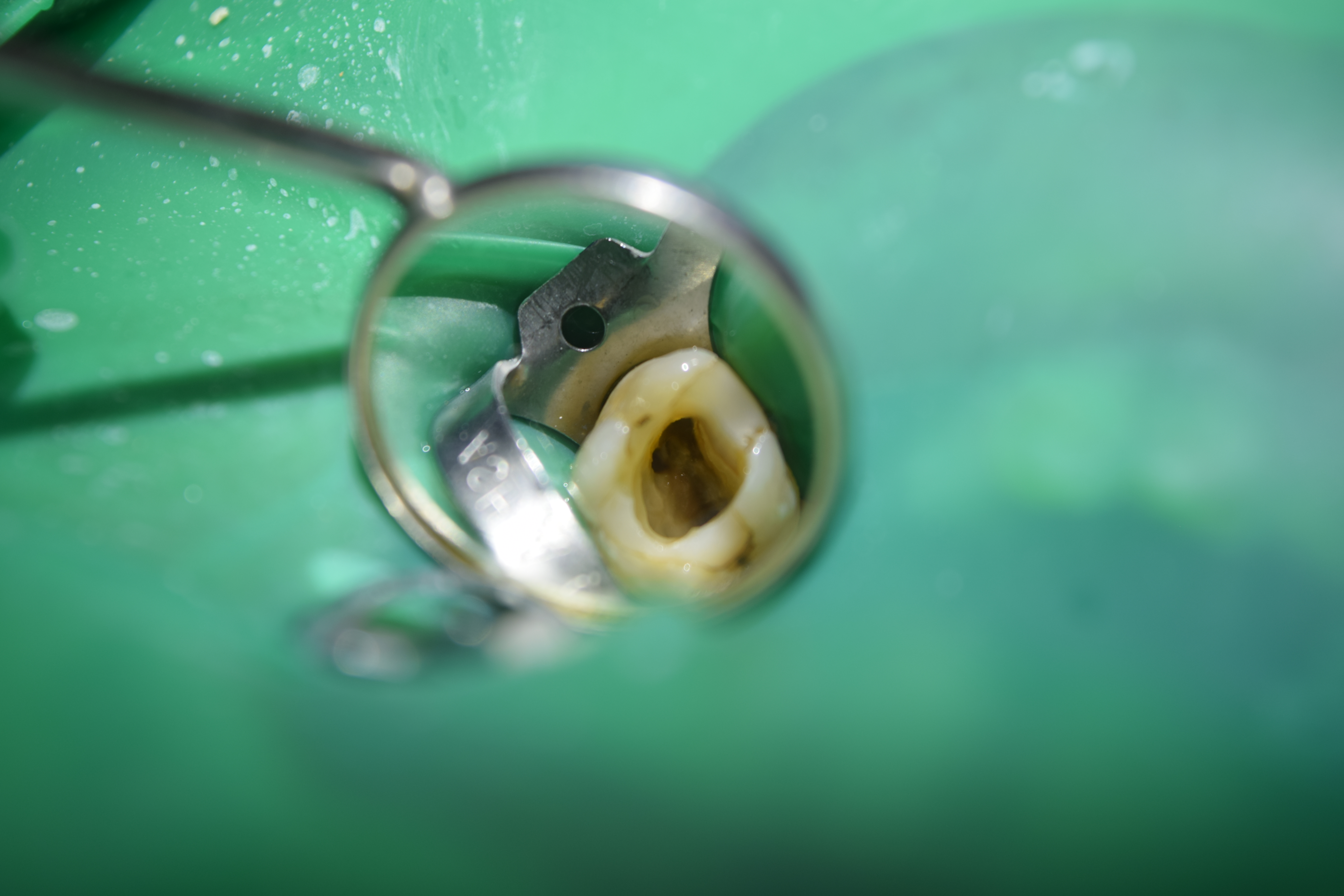 Лечение кариеса зуба под микроскопом в стоматологии Амара