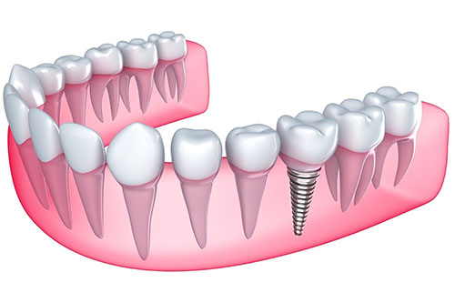 Имплант зуба: нижняя челюсть