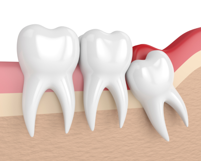Зубы мудрости - повод для обращения к хирургу-стоматологу