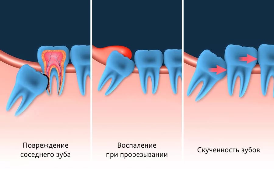 Виды ретенции зубов
